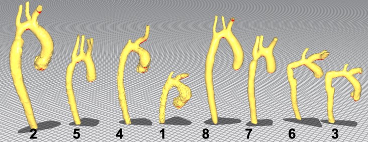 3d models of aortas sorted by visually assessed pairs: 2 & 5, 4 & 1, 8 & 7, 6 & 3, where the second aorta is the smaller one